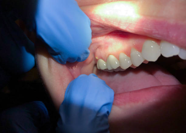 Best Knocked-Out Tooth (Avulsed Tooth) Treatment in Ontonagon, MI